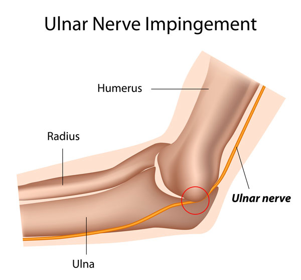 scheme montrant la Compression du nerf ulnaire du coude 
