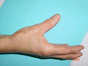 image montrant la mobilite de la main apres une trapezectomie 