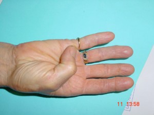 image montrant la mobilite de la main apres une trapezectomie 2
