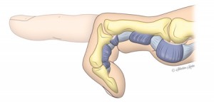 schema detaille du doigt a ressault, blocage du doigt lors de la flexion