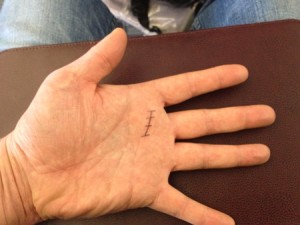 Image photo montrant lendroit de lincision du doit a ressault sur la main