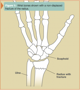 diagram of wrist bones shown with a non displaced fracture of the radius