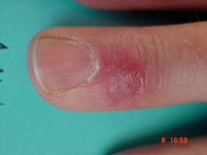 image showing finger one month after ganglion cyst treatment on finger