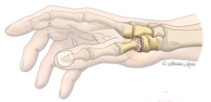 diagram outlining the location of rhizartrosis in the hand
