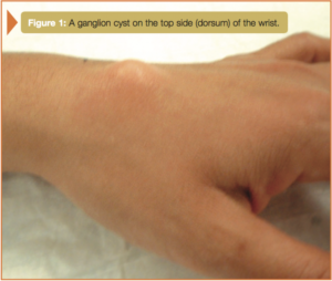 ganglion cyst on the top side (dorsum) of the wrist