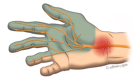 diagram outlining the area where the median nerve compression is located.