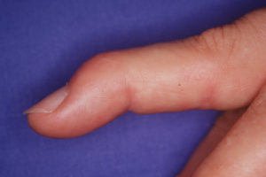 image showing a finger with a mallet finger condition