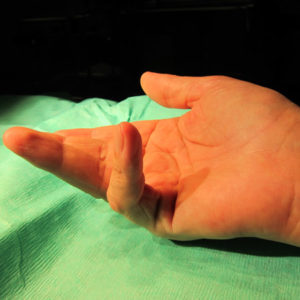 image of a hand with dupuytren disease