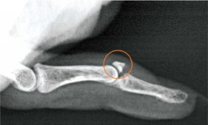 xray indicating location of mallet finger