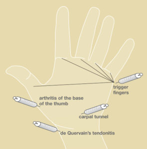 diagram indicating where various steroids can be injected in the hand