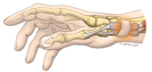diagram outlining the de quervain tenosynovitis brought condition brought on by irritation or inflammation of the wrist tendons at the base of the thumb