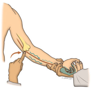 diagram indicating the pain that might arise in the funny bone during ulnar nerve entrapment