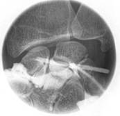 example of an arthrography of the hand