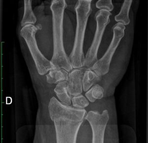 Anteroposterior xray showing an undisplaced fracture of the radius