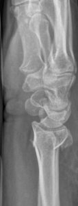 lateral xray showing Displaced extra-articular fracture radius