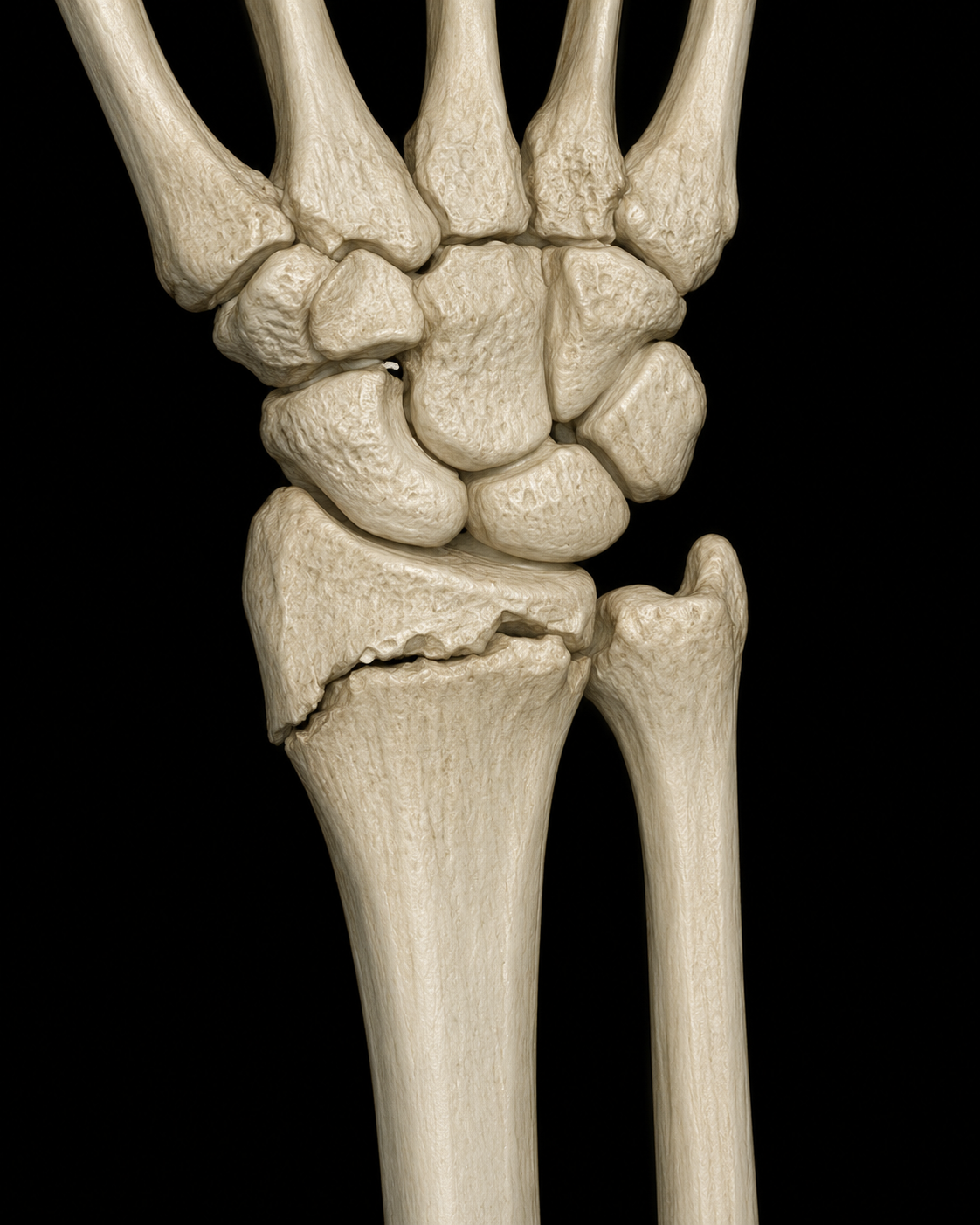 Accidents et fractures du membre supérieur