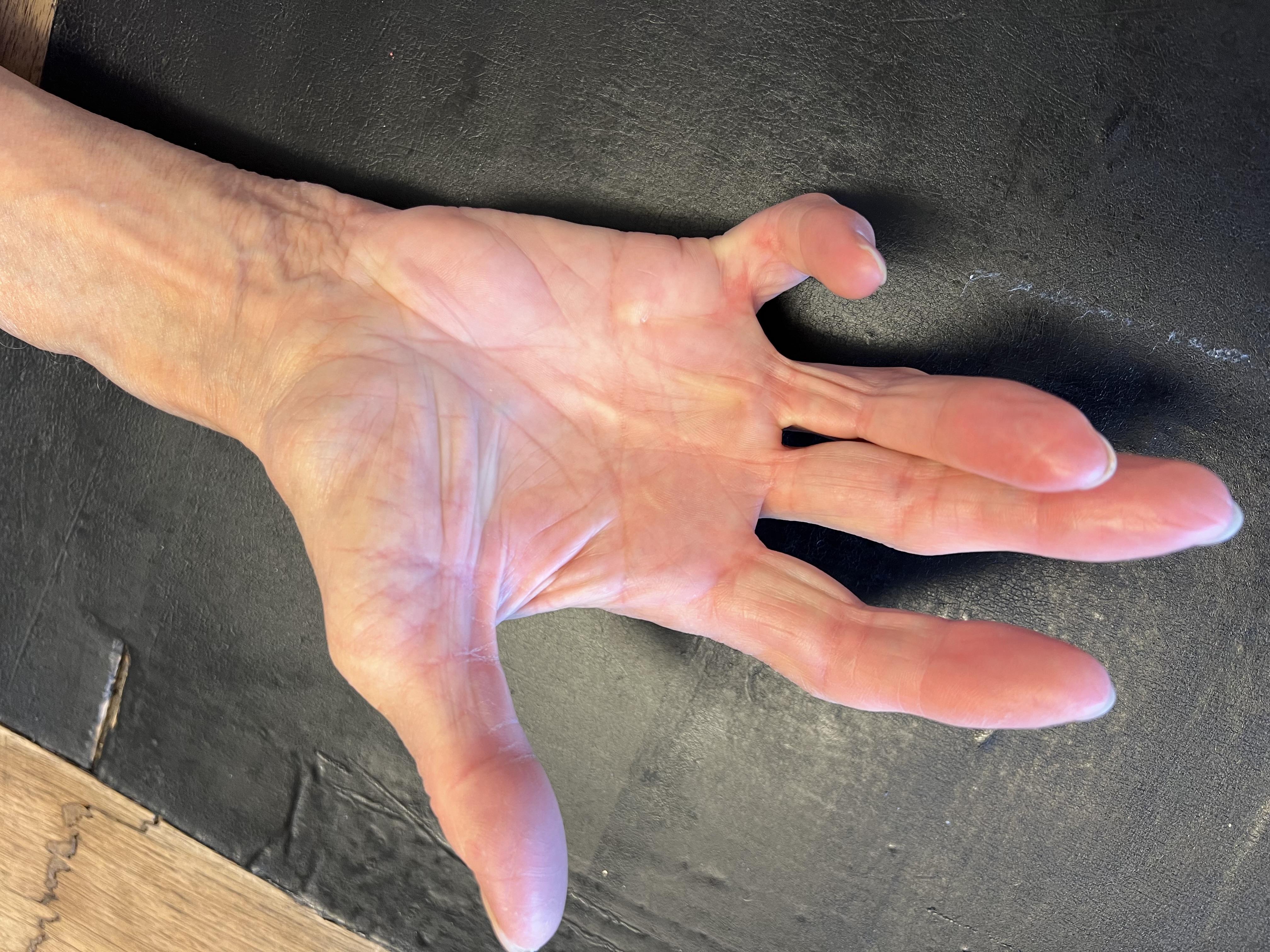 Pathologies complexes de la main
