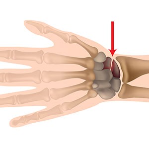 schema indiquant la localisation d'une fracture de poignet